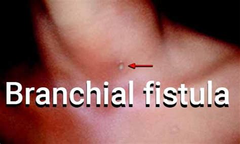 Branchial Fistula Standard Treatment Guidelines By Government Of India