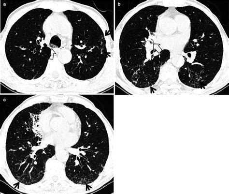 Tree In Bud Sign Radiology Key