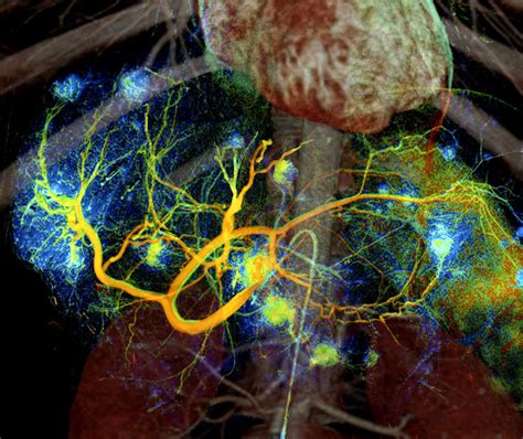 Liver & Bile Duct Cancers | NYU Langone Health