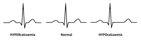 Hypocalcaemia ECG changes • LITFL • ECG Library