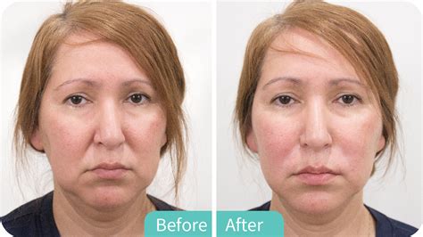 Radiesse Plus Filler Amcc Beauty