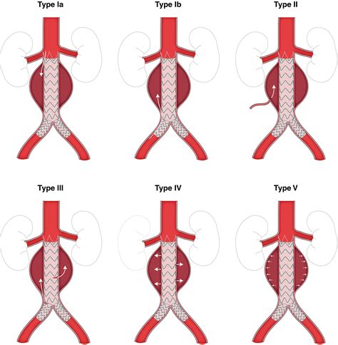 2022 Accaha Guideline For The Diagnosis And Management Of Aortic