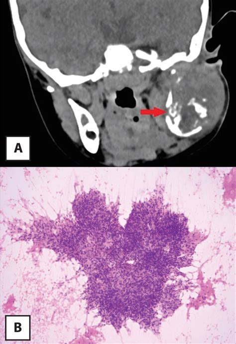 Figure 1 From Parotid Tuberculosis In A Young Child Causing Moth Eaten