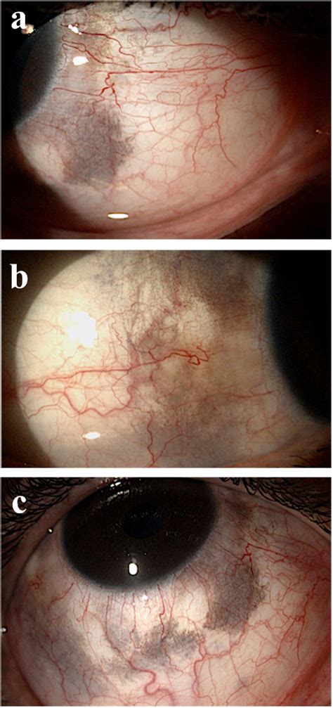 Figure 1 From Utility Of Anterior Segment Optical Coherence Tomography