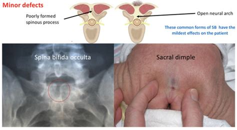 Spina Bifida Occulta Dimple