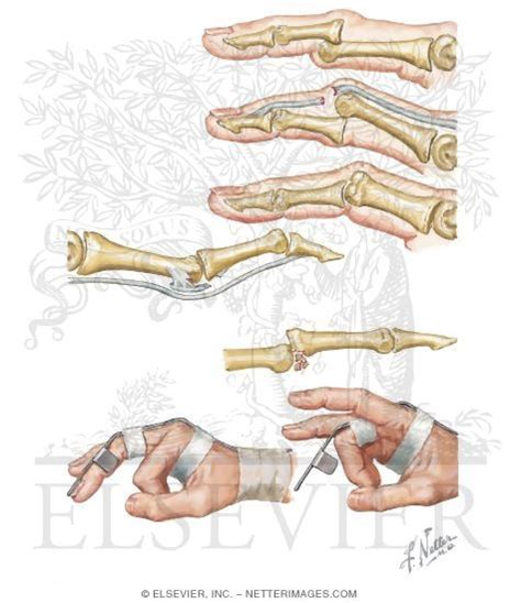 Dorsal and Palmar Interphalangeal Joint Dislocations