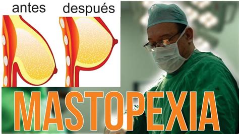 Reducci N Y Levantamiento De Mamas Mastopexia Dr Alberto Calvo