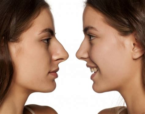 Rhinoplastie Le Co T Et La Qualit Des Services En France