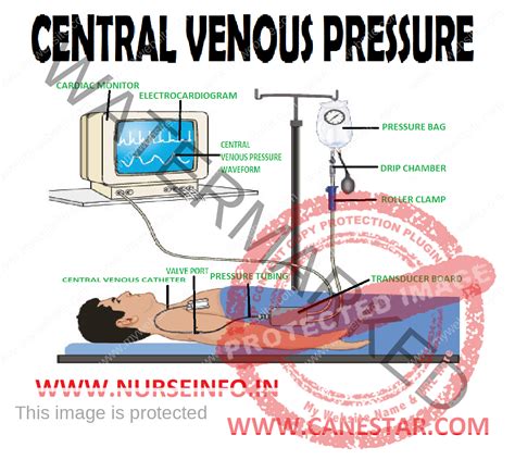 Central Venous Catheters Stenosis At Drew Larue Blog