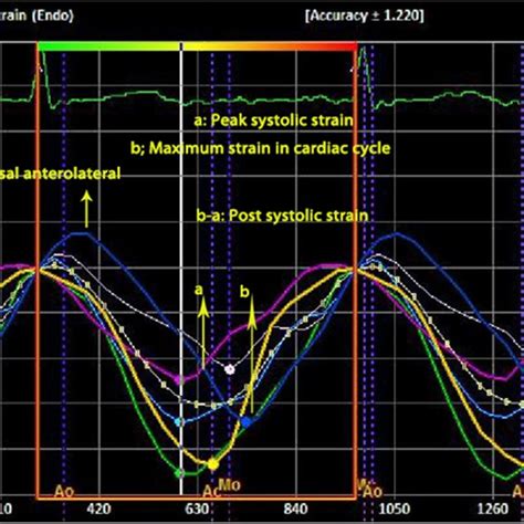 Speckle Tracking Echocardiography In Apical Four Chamber View