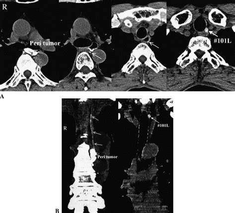 Ct Lymphography Navigated Sentinel Lymph Node Biopsy In Patients With