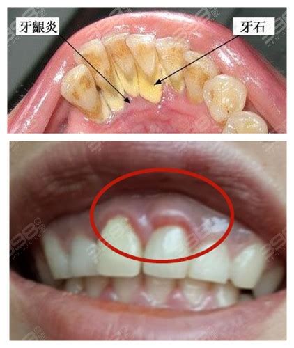 牙龈炎是什么样？看牙龈炎图片及治疗方法了解它行业资讯草珊瑚口腔