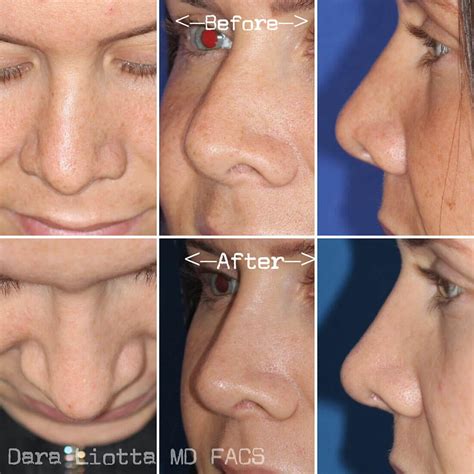 Revision Rhinoplasty Dr Dara Liotta