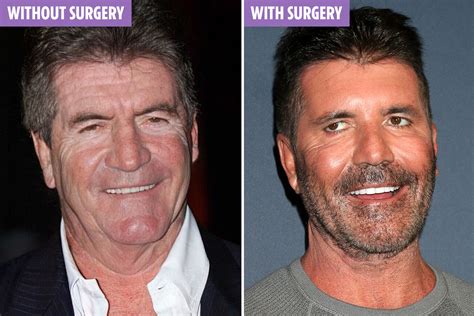 Has Simon Cowell Had Plastic Surgery on His Face? | Bizrahmed