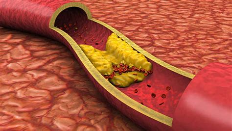 What Is Arteriosclerosis Articlesubmited