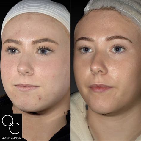 Dermal Facial Fillers Quinn Clinics Bristol