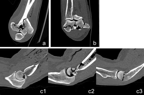 Exemplary Ct Cross Sections Of A Typical Humerus Fracture Pattern Download Scientific Diagram