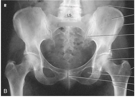 AP Pelvis X-Ray Anatomy Diagram | Quizlet