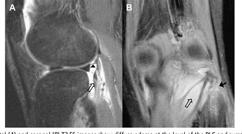 Figure From Posterolateral And Posteromedial Corner Injuries Of The