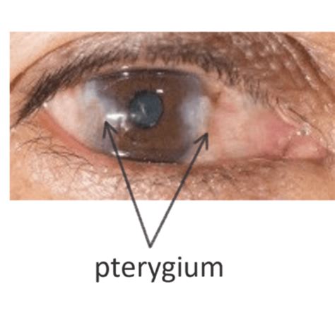 Pinguecula and Pterygium (sometimes called “Surfer’s eye”) – Ask Eye Doc