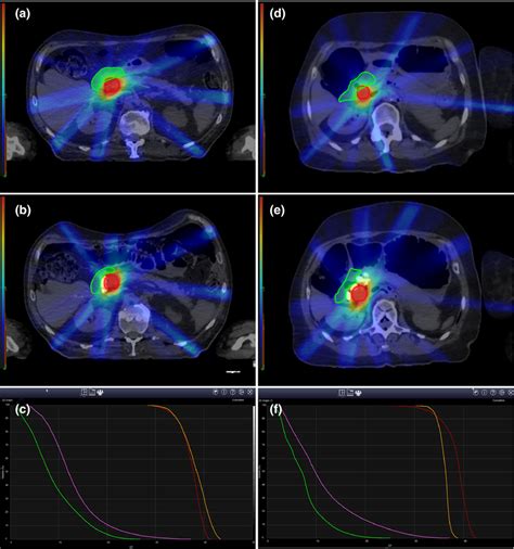 Comparison Of Planning Target Volume PTV On Simulation Planning CT