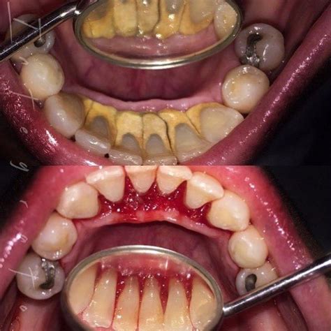 Apto boicotear danés calculos dientes Volverse Insistir Explicación