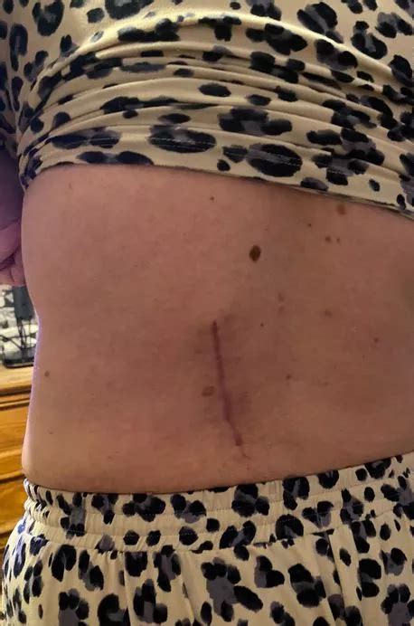 Mum Says Holiday Hot Tub Saved Her Life When It Found Her Cancer Devon Live