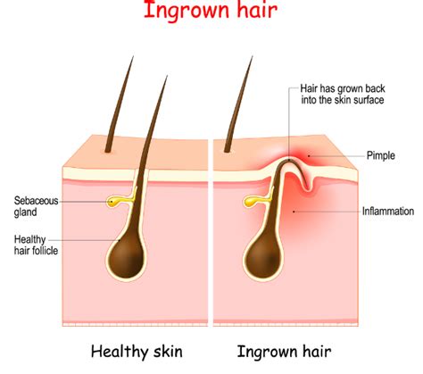 Ingrown Hair What It Looks Like Causes Treatment 45 Off