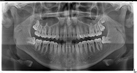 Radiology: Panoramic Normal Radiographic Anatomy Diagram | Quizlet