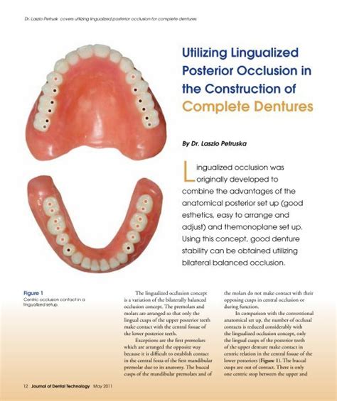 Complete Dentures Jdt Unbound