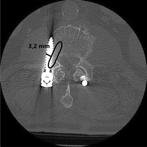 Assessment Of The Pedicle Screw Position Using The Download Scientific Diagram