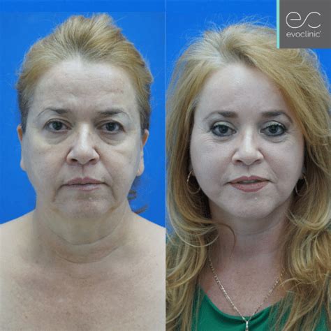 Face Lift Full Mini Before And After Evoclinic