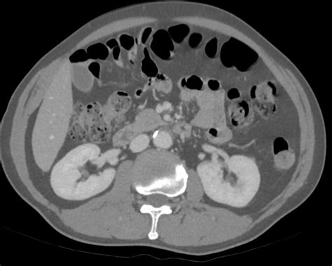 CT scan Kidneys | Kidney