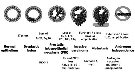 Possible Pathway For Human Prostate Cancer Progression Every Stage Of