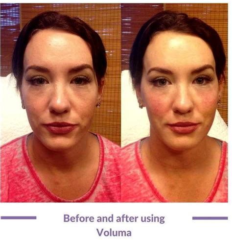 Before And After Injection Of Dermal Filler Under The Eyes And Cheeks By Facial Injections