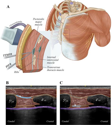 Comparison Of Ultrasound Guided Pecto Intercostal Fascial Block And