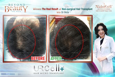 Stem Cell Based Hair Transplant For More Natural Healthier And Thicker Hair