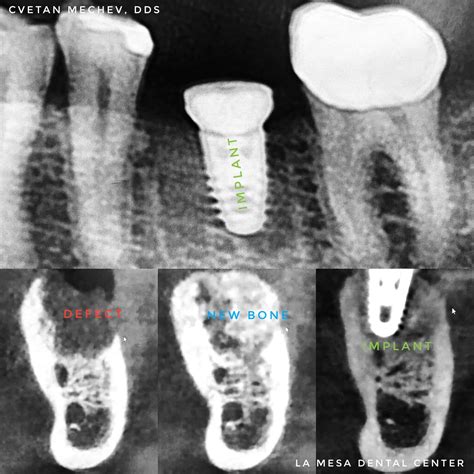 Vertical And Horizontal Ridge Augmentation New Pe