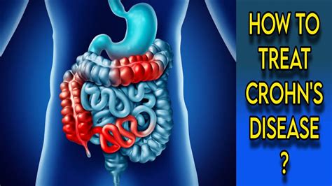 Crohns Disease Treatment Crohns Disease Symptoms And Signs Crohns