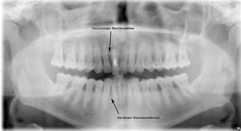 Opg Orthopantomogramm Panorama Schichtaufnahme Des Kiefers