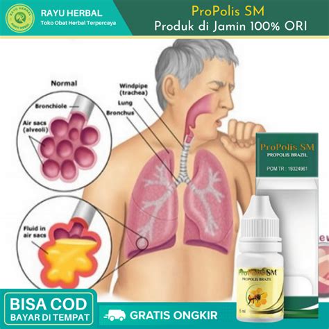 Jual Obat TBC Radang Paru Paru Basah Pneumonia Infeksi Paru Paru