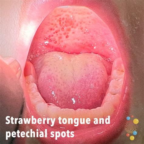 White Strawberry Tongue