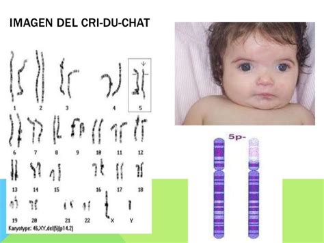 Padeciemientos Debido A Monsomias S Ndrome Cri Du Chat O Del Maullido