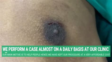 Swollen Nipple Pics Telegraph