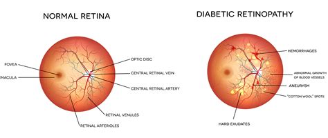 Type 2 Diabetes Complications