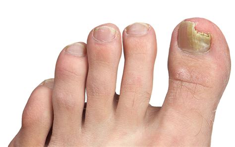 Fungal Nail Infection (Onychomycosis)