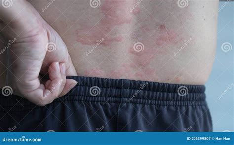 Allergy or Urticaria or Hives or Kaligata on Back Stock Image - Image ...