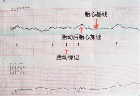 胎心率低于140是男孩；高于140是女孩？关于胎心率，你一定要知道的事！ 知乎