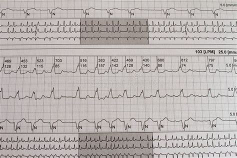 Elettrocardiogramma Con Aritmia Cardiaca Paziente Con Fibrillazione