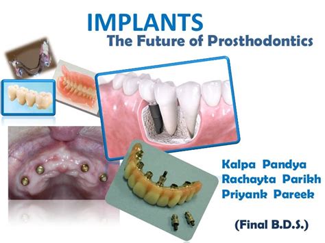 Implants the future of prosthodontics